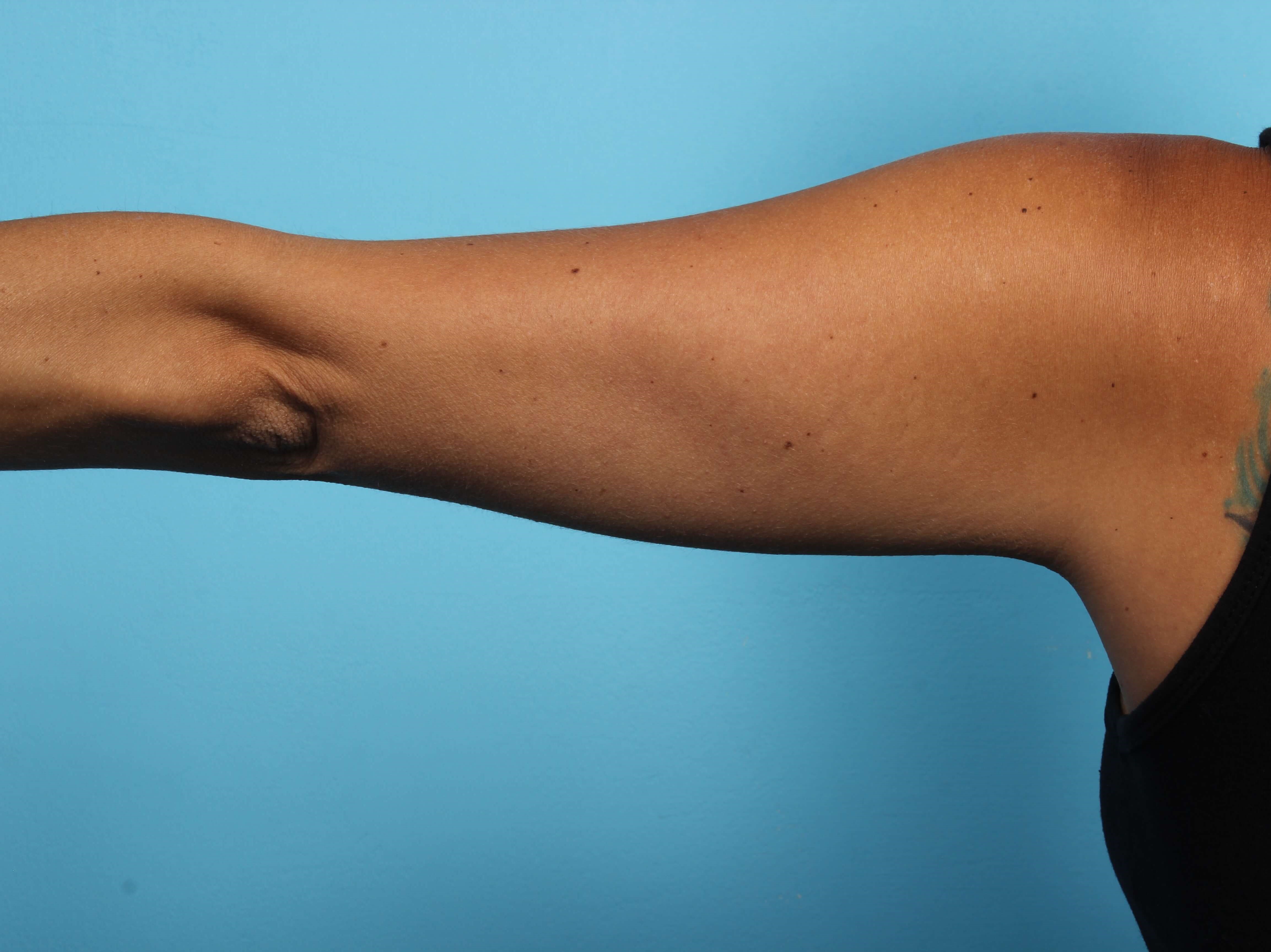 Before and After CoolSculpting Photos Before and After CoolSculpting Photos