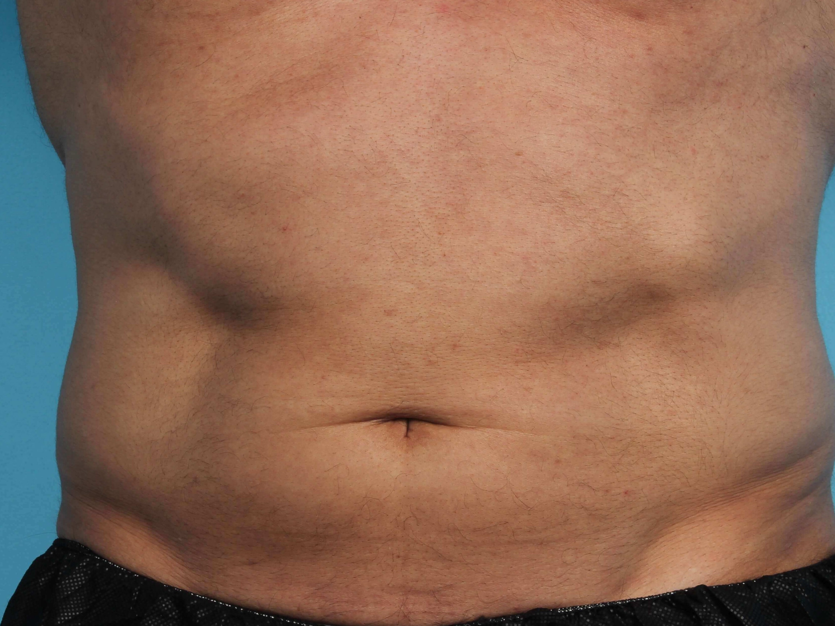 Before and After CoolSculpting & CoolTone Photos Before and After CoolSculpting & CoolTone Photos
