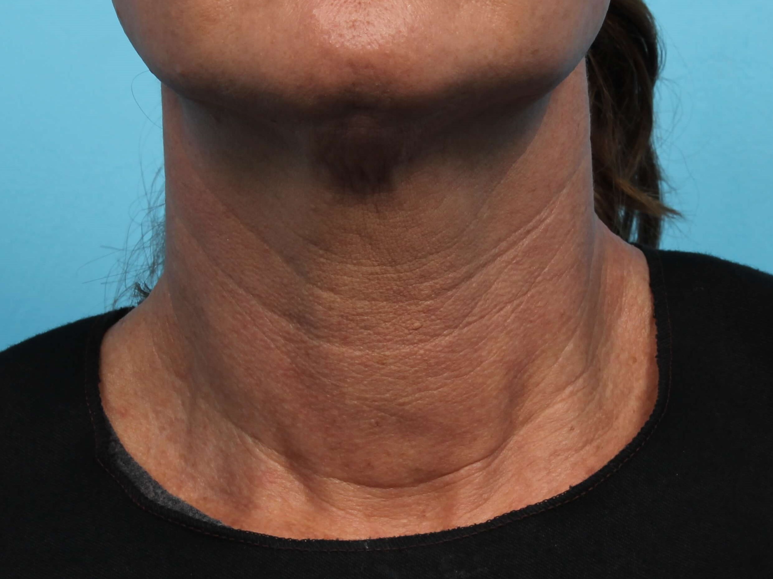 Before and After Laser Skin Tightening Photos