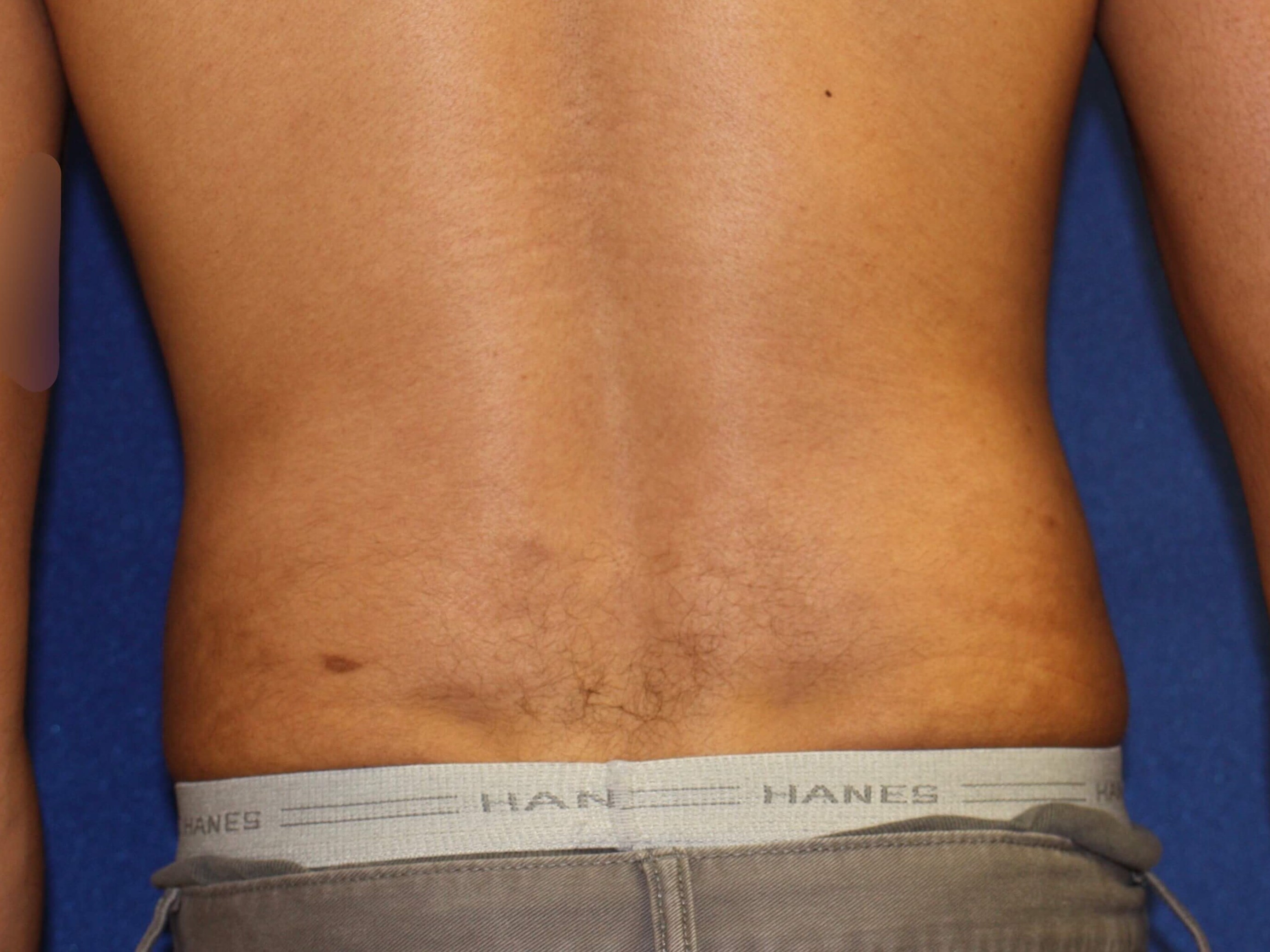 Before and After Liposuction Photos