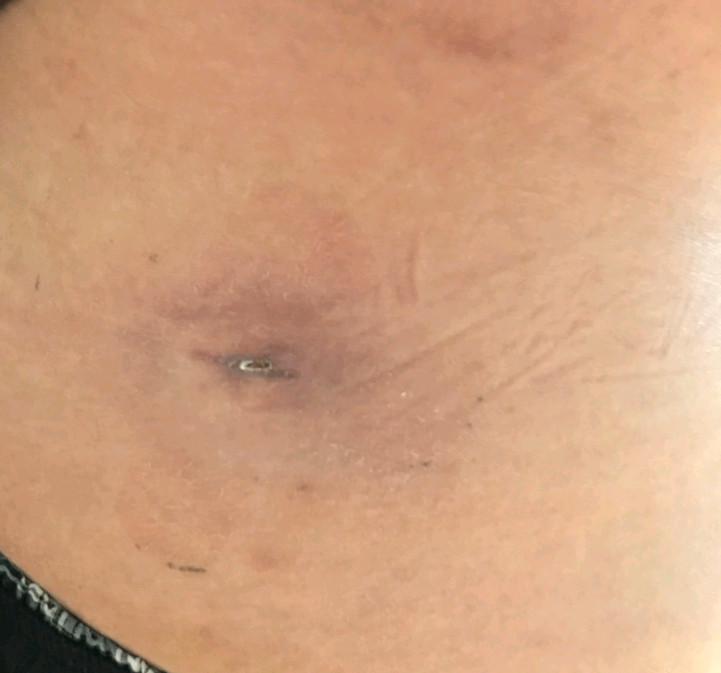 Infected Sebaceous Cyst