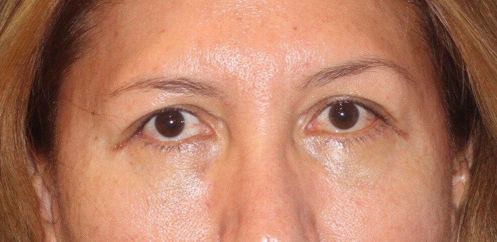 Before and After Eyelid Lift Photos