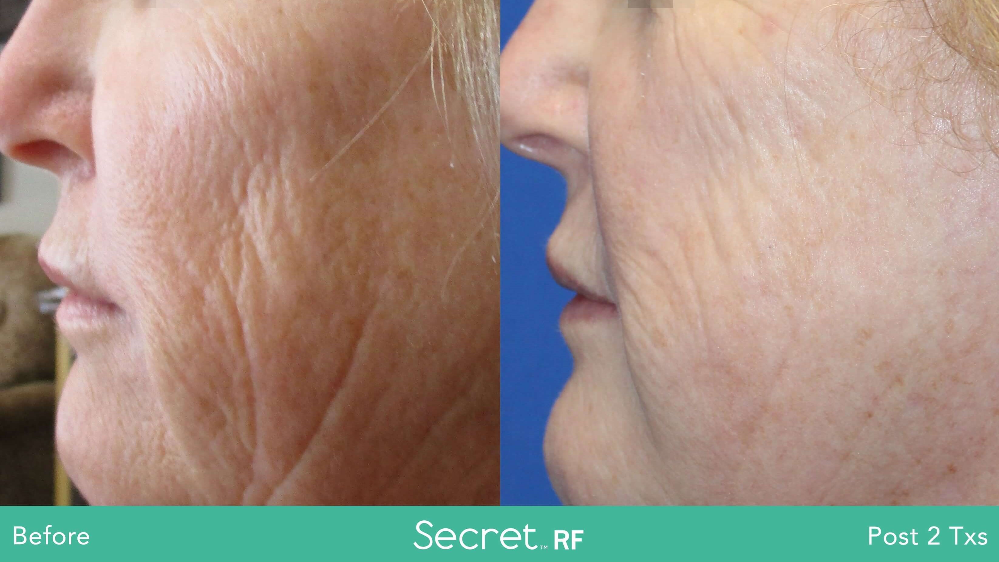 Secret Rf Microneedling