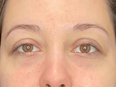 Before and After Cosmetic Injections Photos
