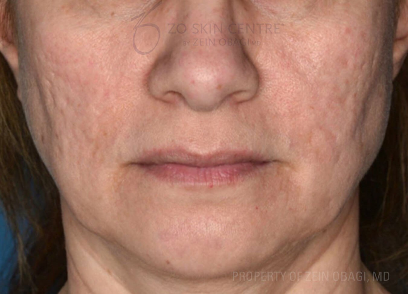 ZO Controlled Depth Peel Laser Results For Acne Scars In Be