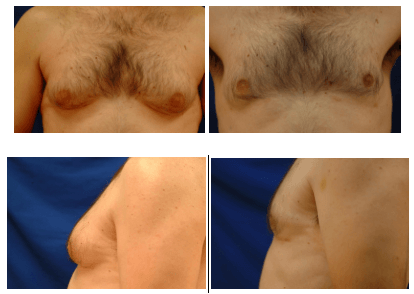 Image result for gynecomastia condition