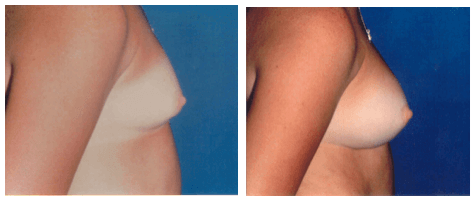Breast Enlargement