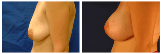 Breast Lift