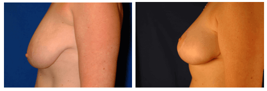 Breast Lift