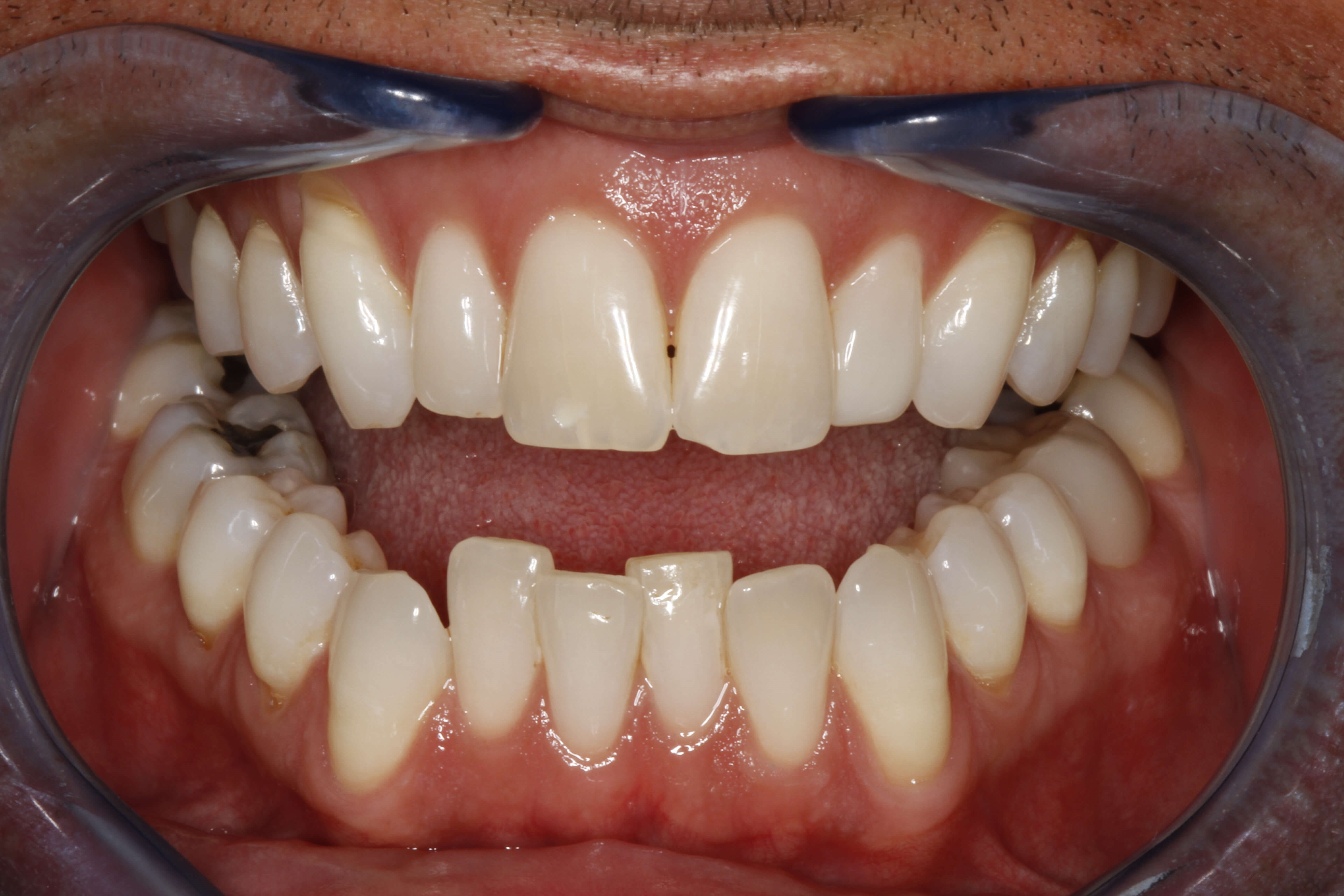 Before and After ZOOM! Whitening & Dental Bonding and ... Before and After ZOOM! Whitening & Dental Bonding and ...