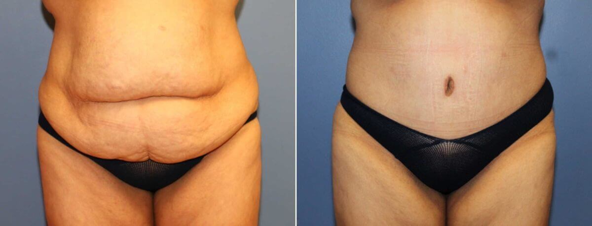 Before And After After Weight Loss Surgery Tummy Tuck Photos