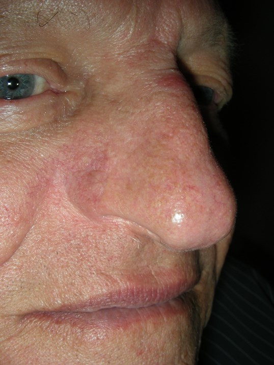 Before And After Mohs Surgery Skin Flaps Basal Cell Carcinoma