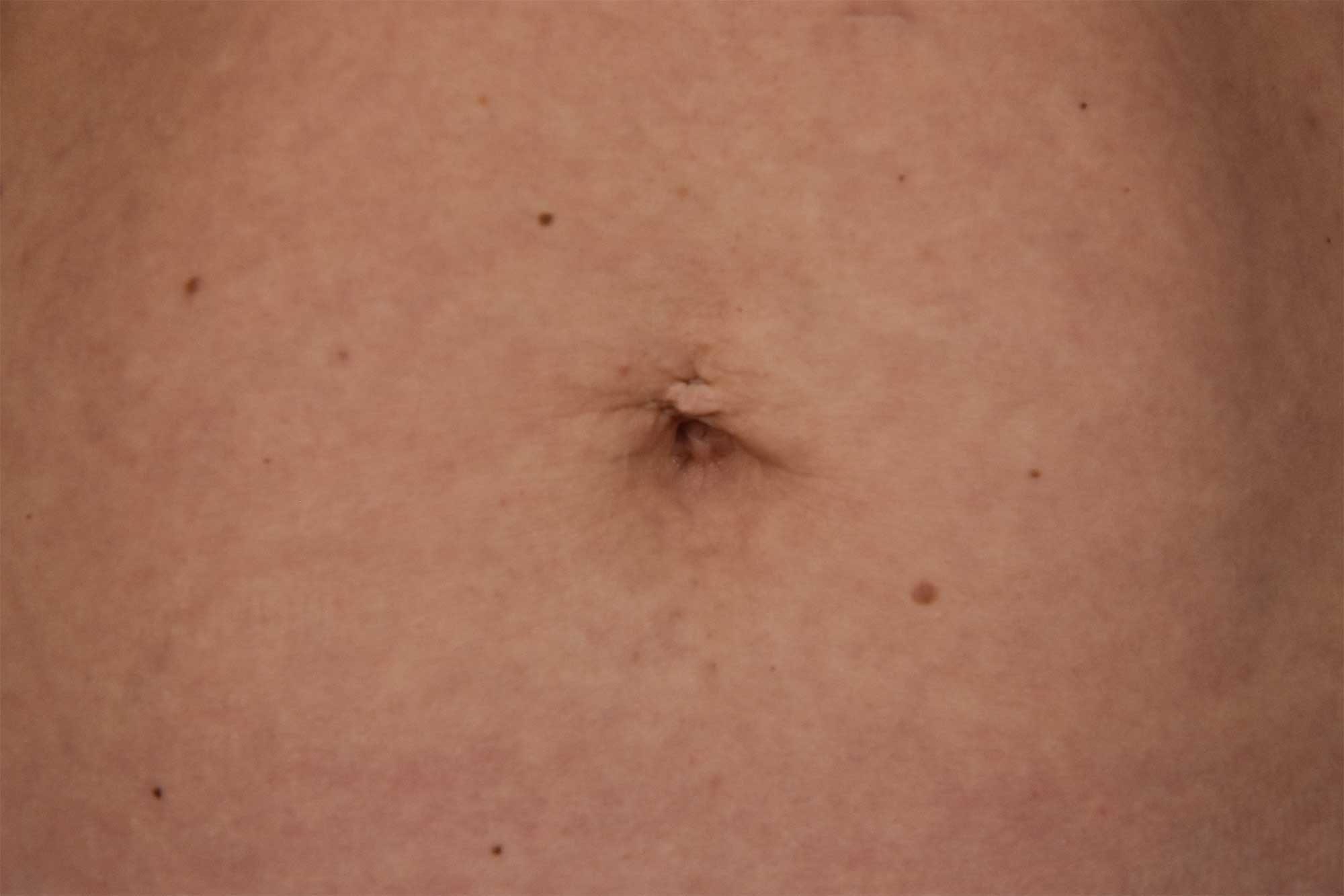 navel piercing scar removal