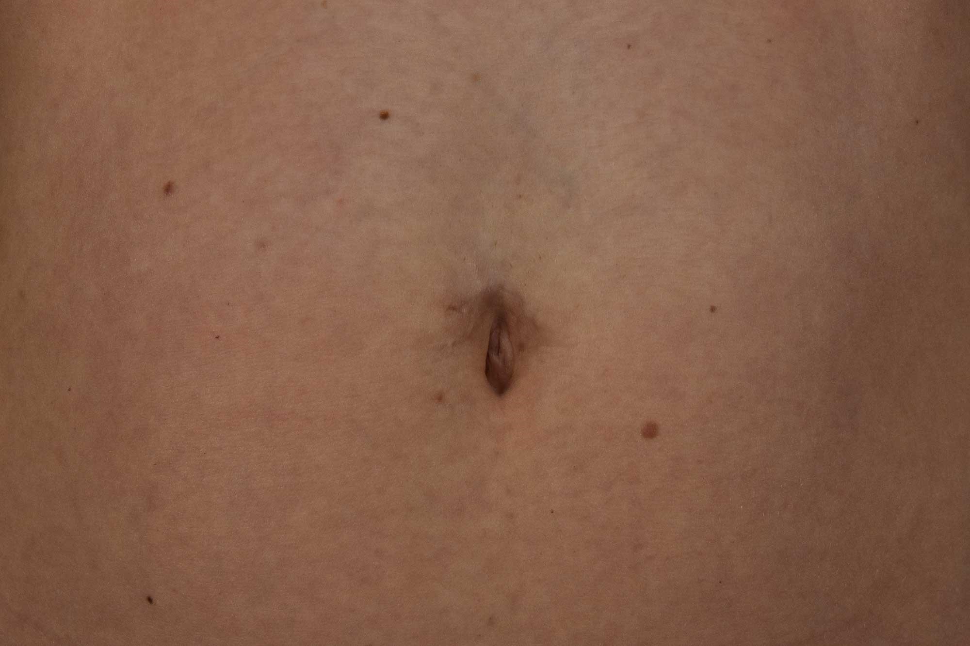 Belly on sale ring scar