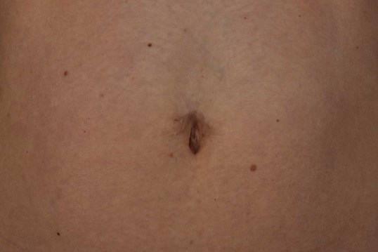 Belly Button Piercing Revision: How To Remove My Scar