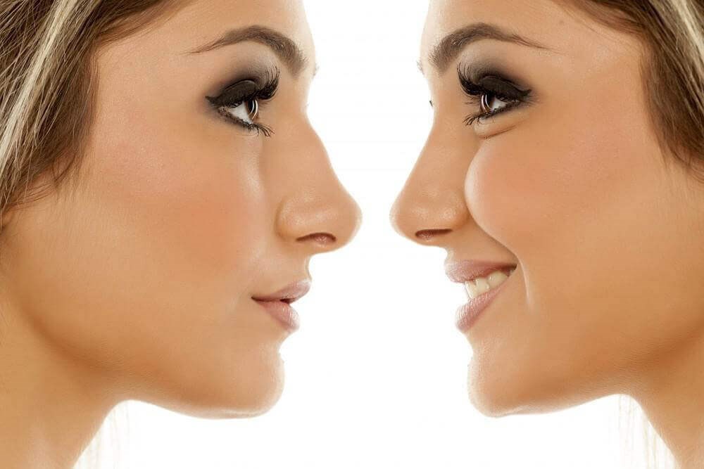 The Secret to a Natural-looking Rhinoplasty (aka Nose Job)