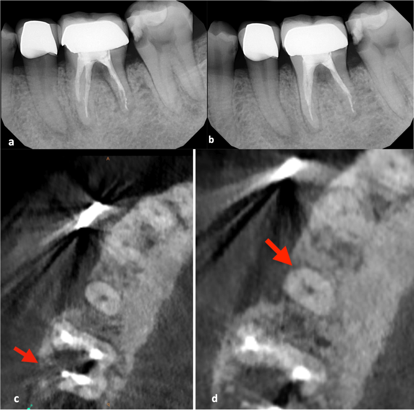 CBCT and Root Canal Retreatmen