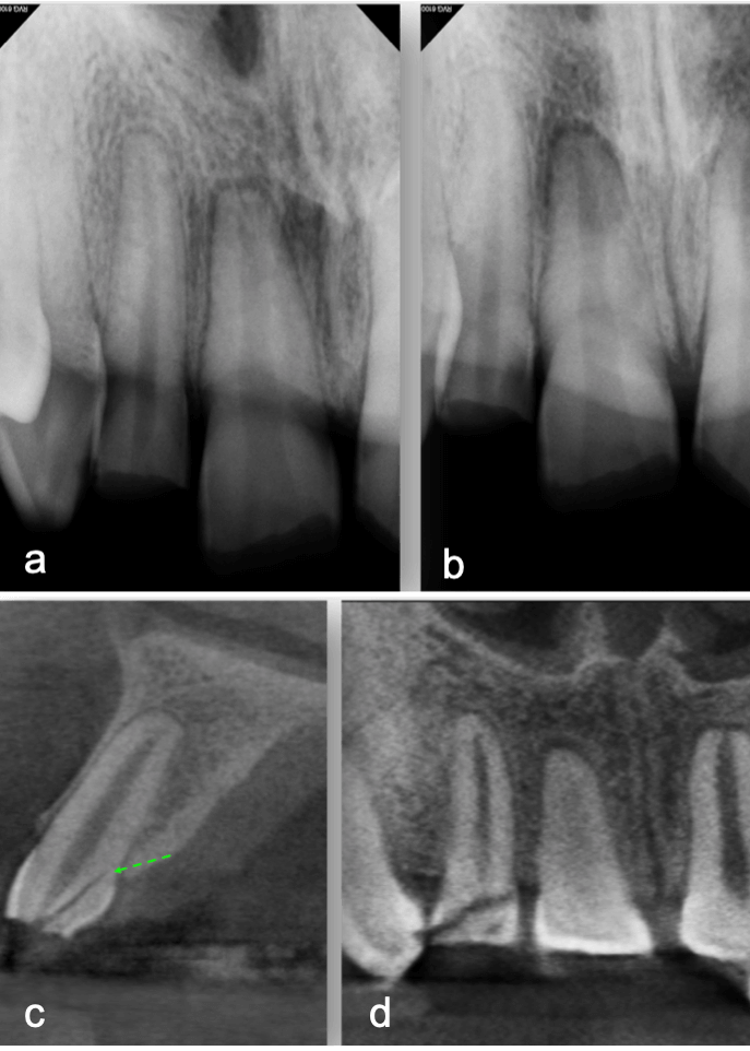 CBCT and Traumatic Dental Inju