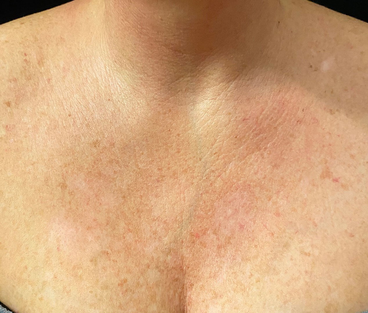 Before and After Opus™ Photos