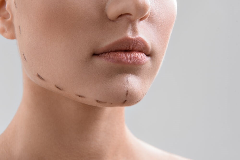 Chin With Surgical Lines Photo