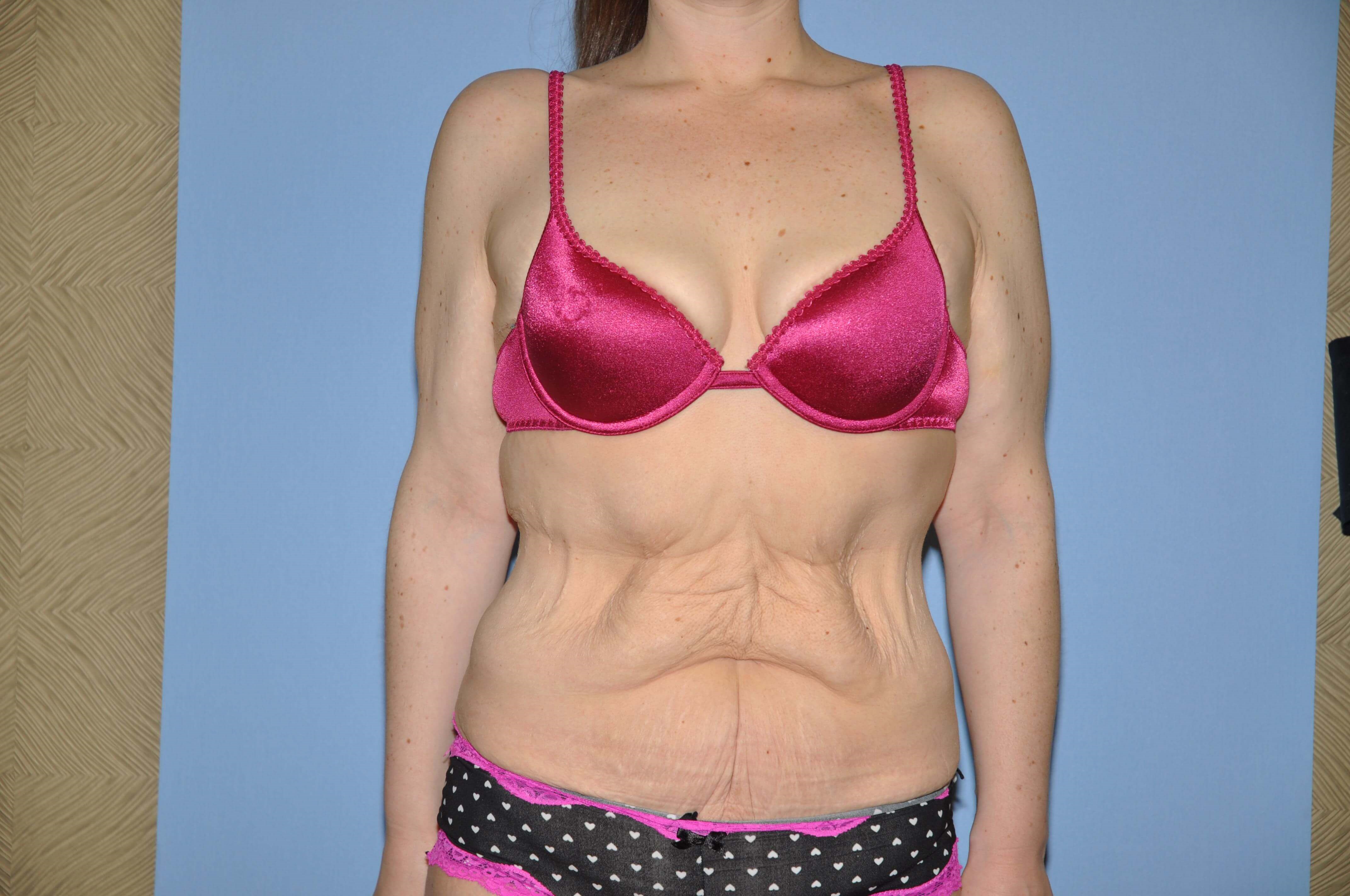 Before And After Tummy Tuck After Weight Loss Surgery Photos