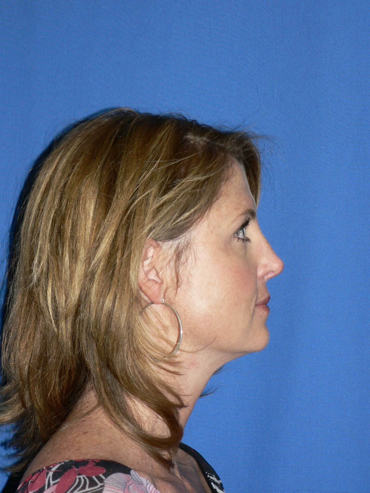Before and After Rhinoplasty & Septoplasty Photos