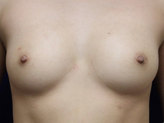 TUBA Implants Before and After Before Breast Implants