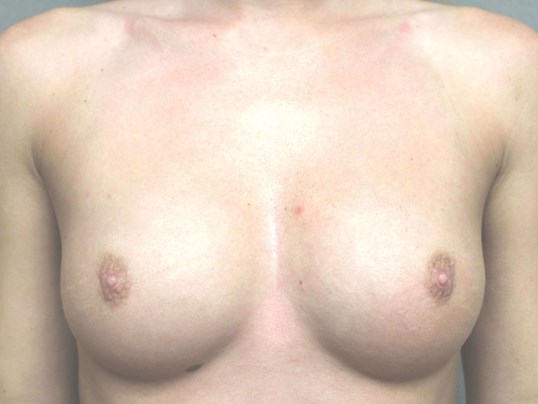 Breast Augmentation Before Breast Implants