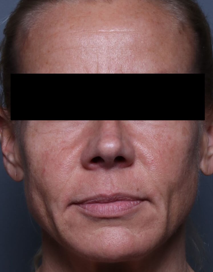 Before And After Skin Tightening Lifting Laser Skin Resurfacing Photos