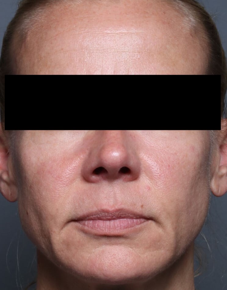 Before And After Skin Tightening Lifting Laser Skin Resurfacing Photos
