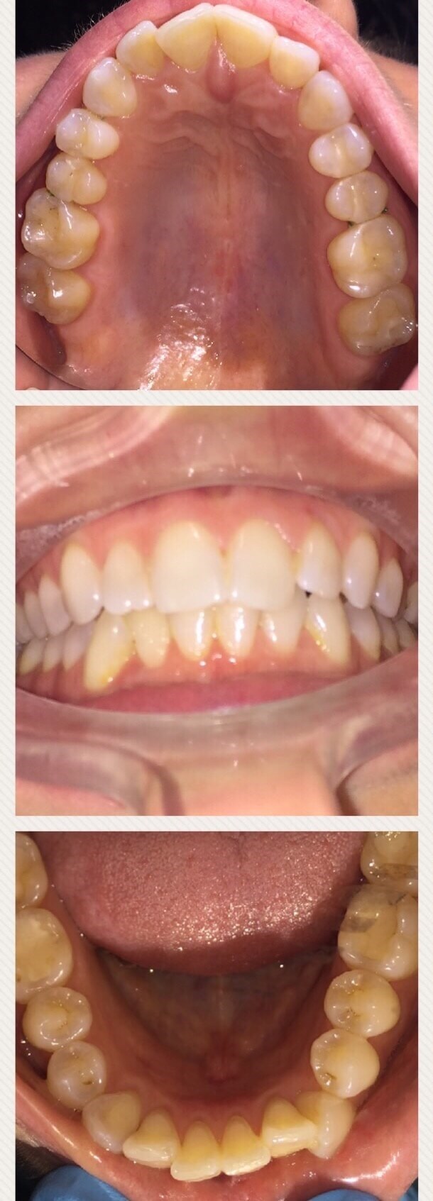 Before And After Invisalign Orthodontics Photos