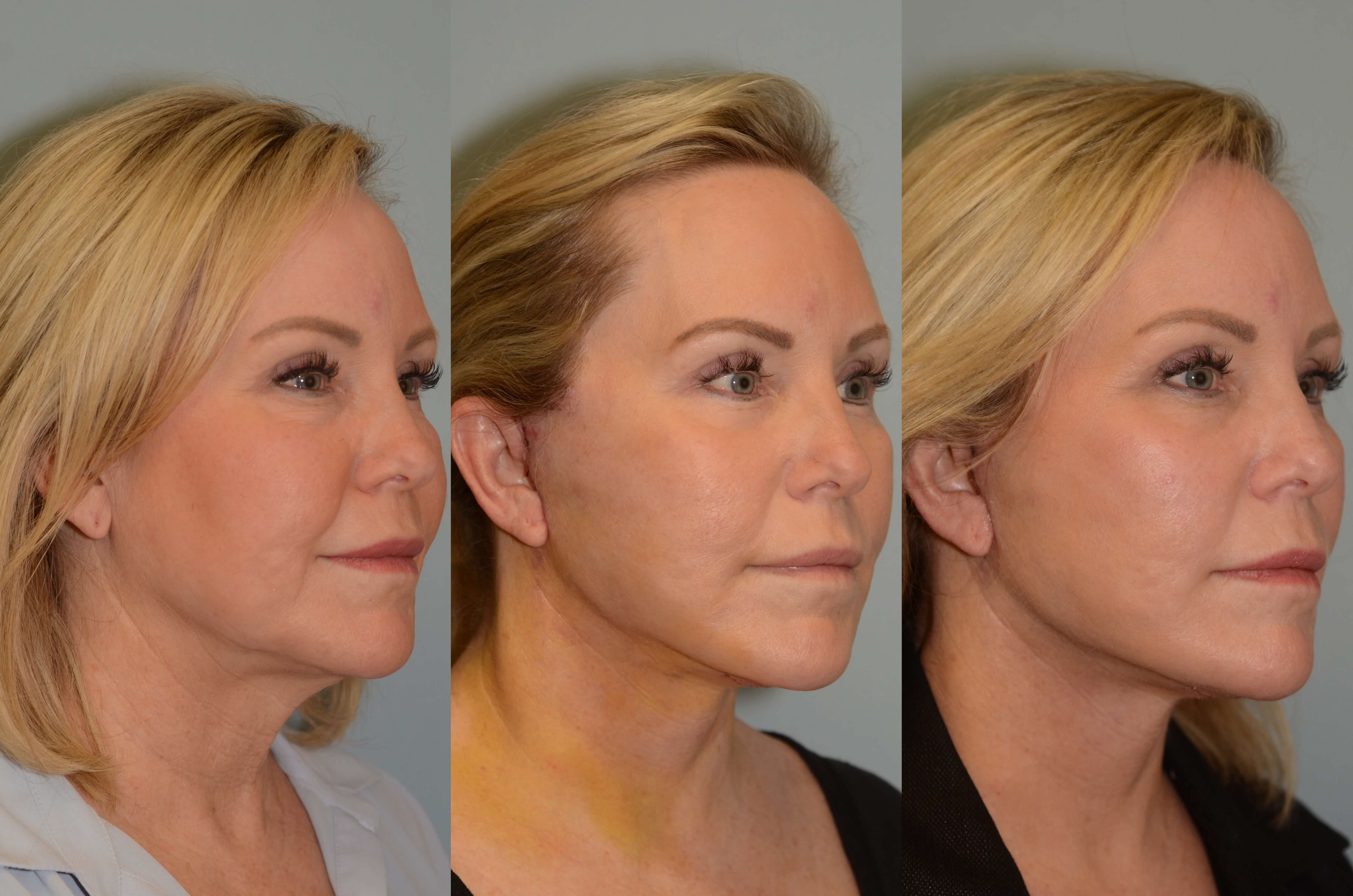 Before and After Facelift & Neck Lift Photos
