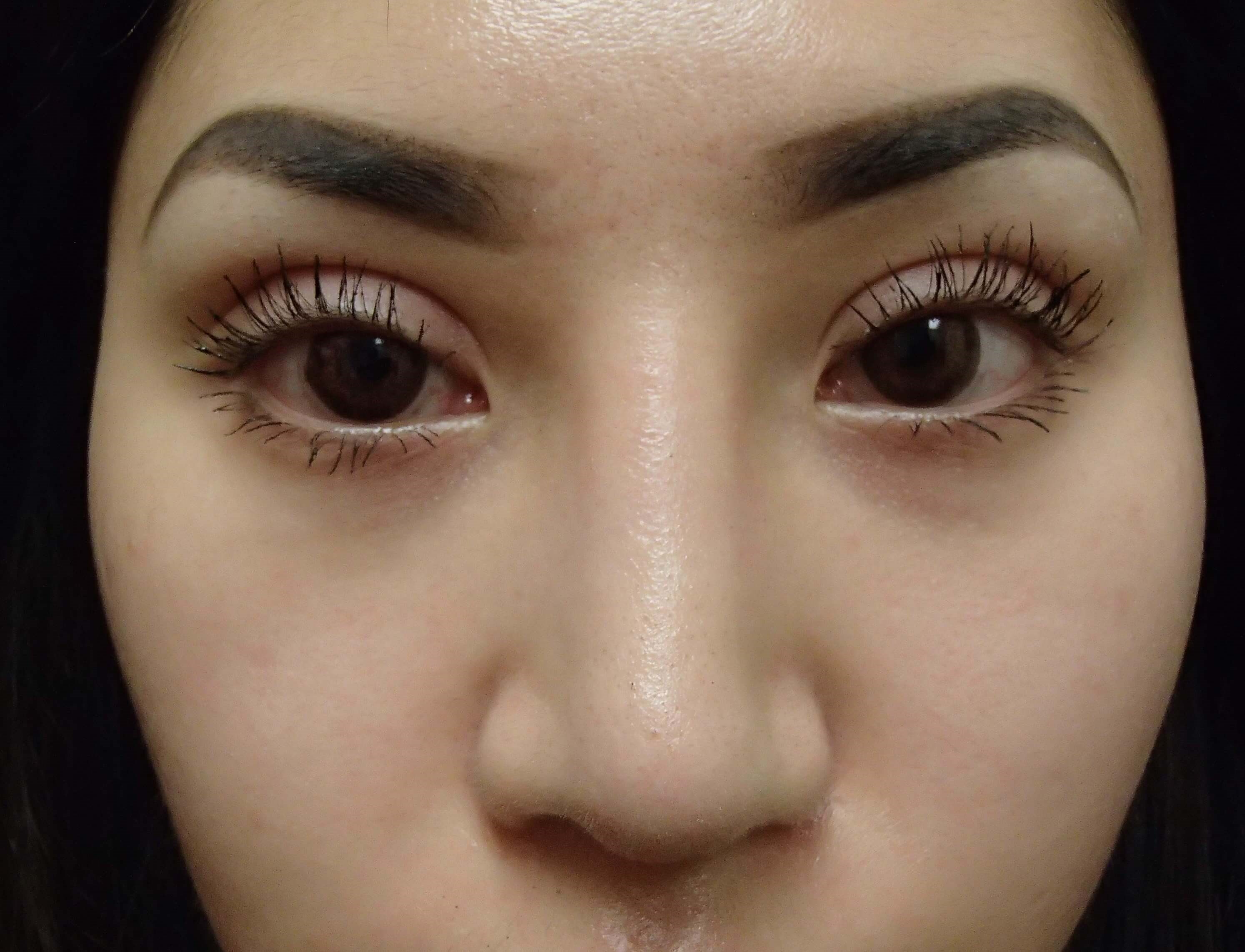 asian eyelid surgery