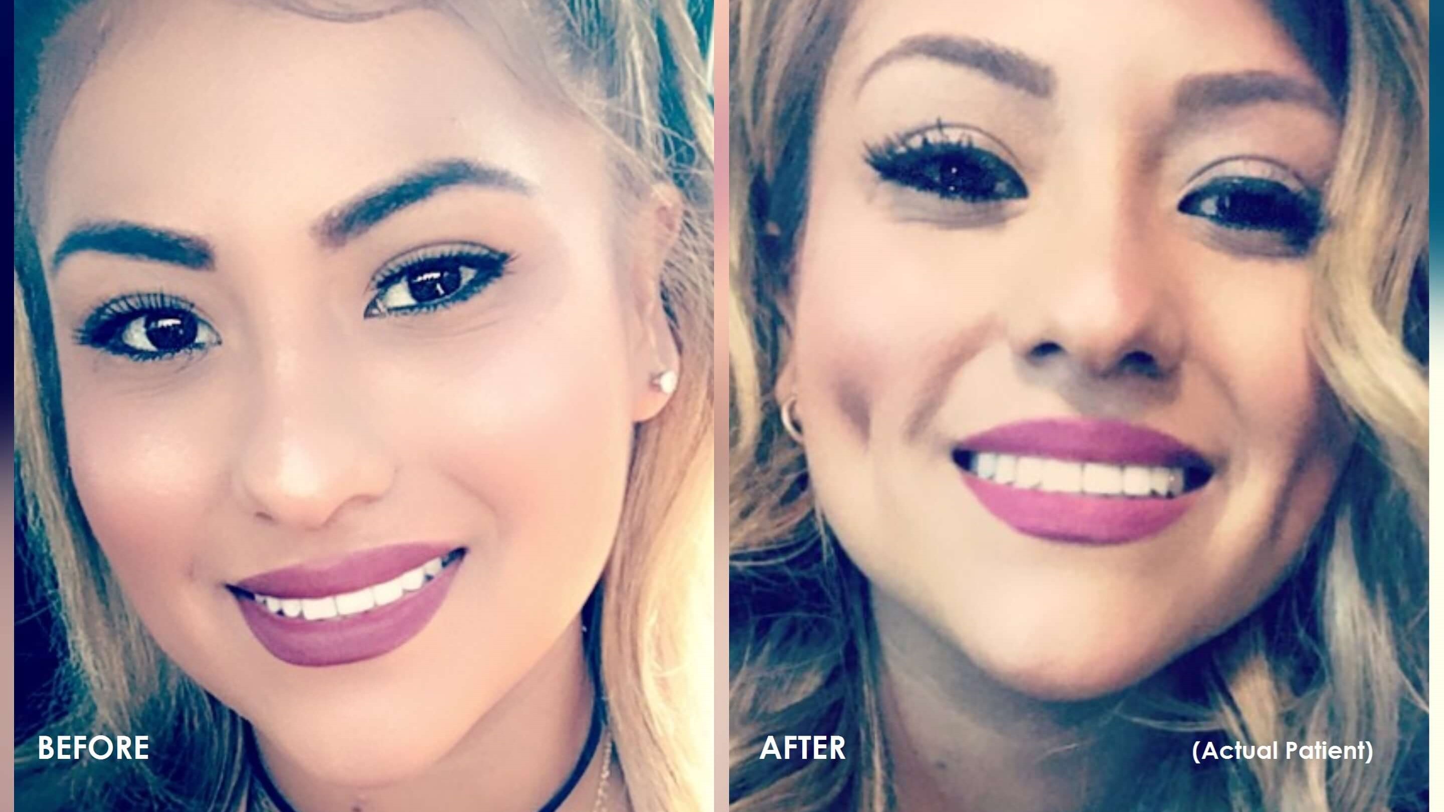 Is Dimpleplasty Worth It? The Timeless Dimple Definitely Is! Is Dimpleplasty Worth It? The Timeless Dimple Definitely Is!