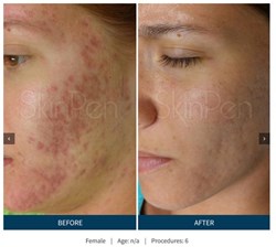 SkinPen2