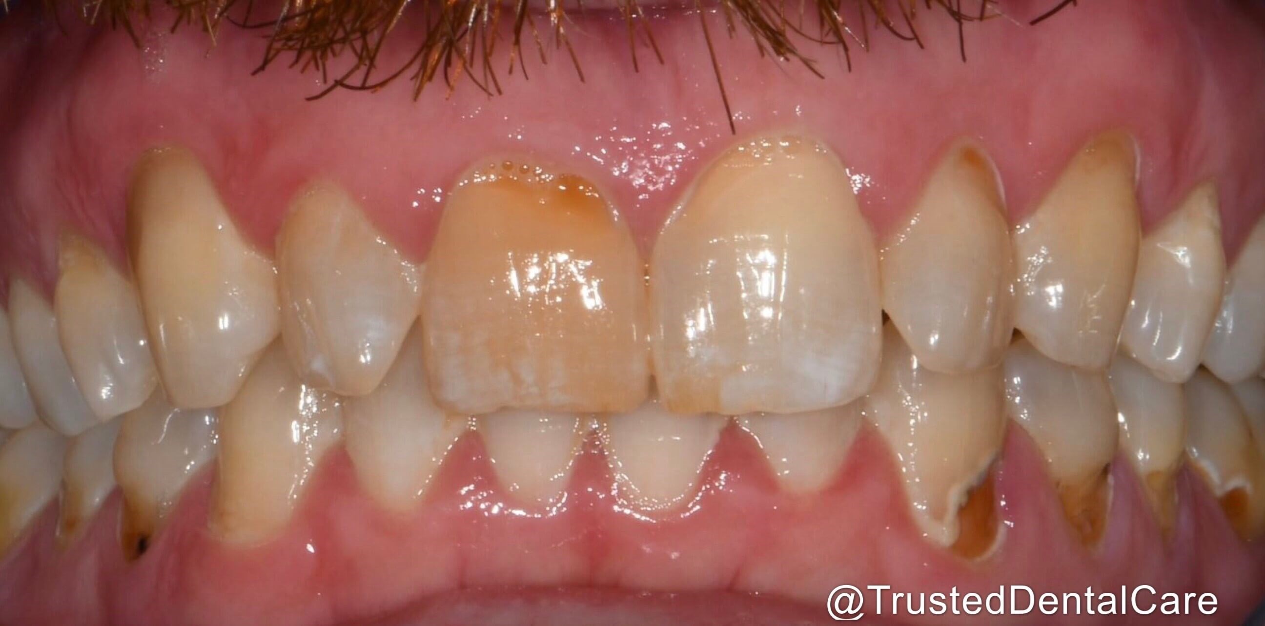 Before and After Smile Makeover & Dental Bonding and ... Before and After Smile Makeover & Dental Bonding and ...