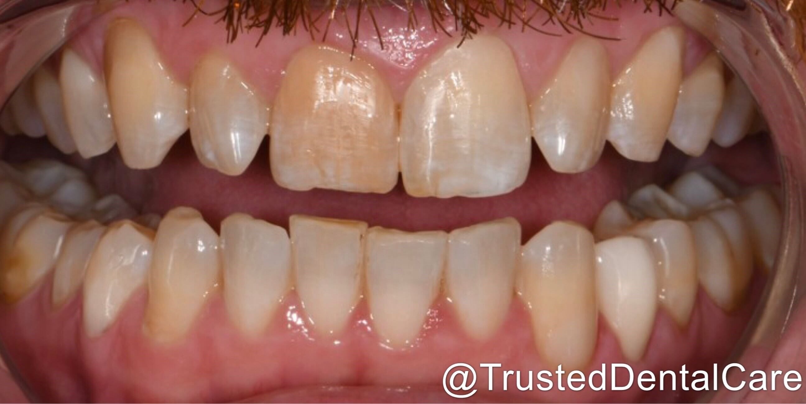 Before and After Smile Makeover & Dental Bonding and ... Before and After Smile Makeover & Dental Bonding and ...