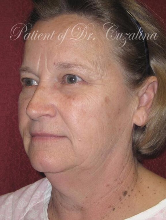 Before and After Brow Lift & Laser Skin Resurfacing