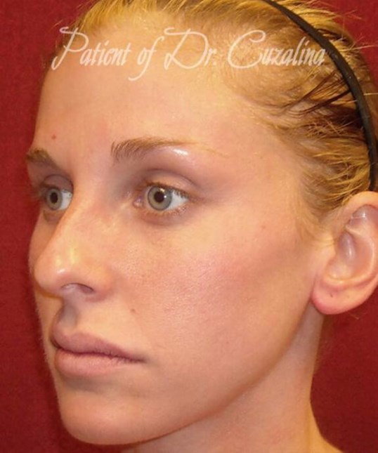 Before and After Rhinoplasty Photos