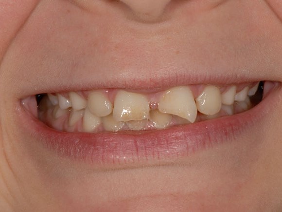 Before and After Dental Bonding and Contouring Photos Before and After Dental Bonding and Contouring Photos