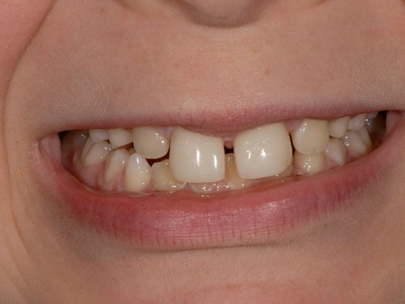Before and After Dental Bonding and Contouring Photos Before and After Dental Bonding and Contouring Photos