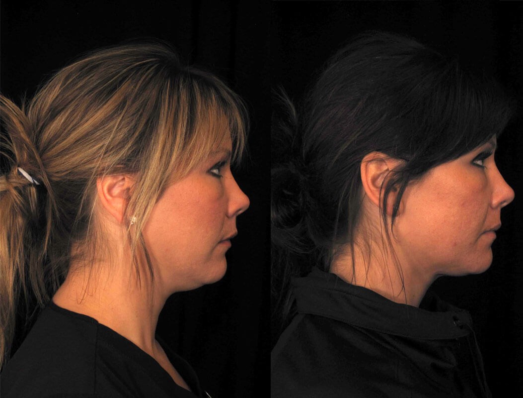 Kybella before and after