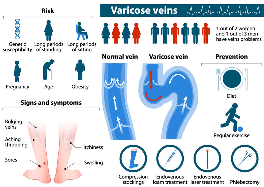 Varicose Veins