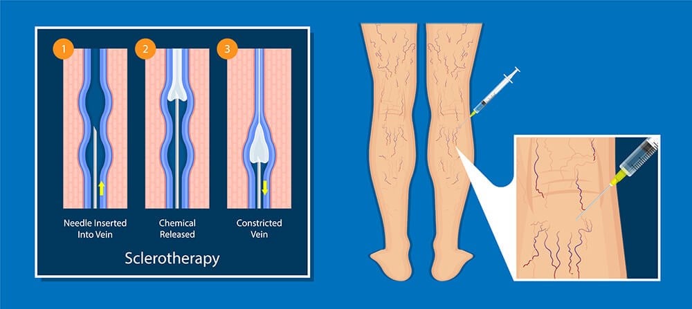 Sclerotherapy