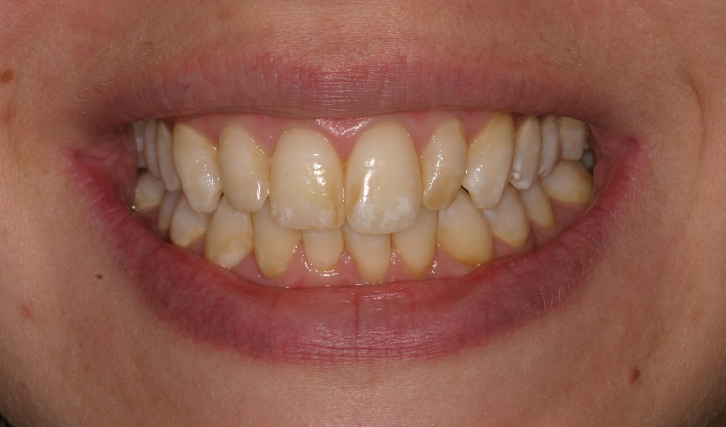 Before And After Porcelain Veneers Photos before-and-after-porcelain-veneers-photos