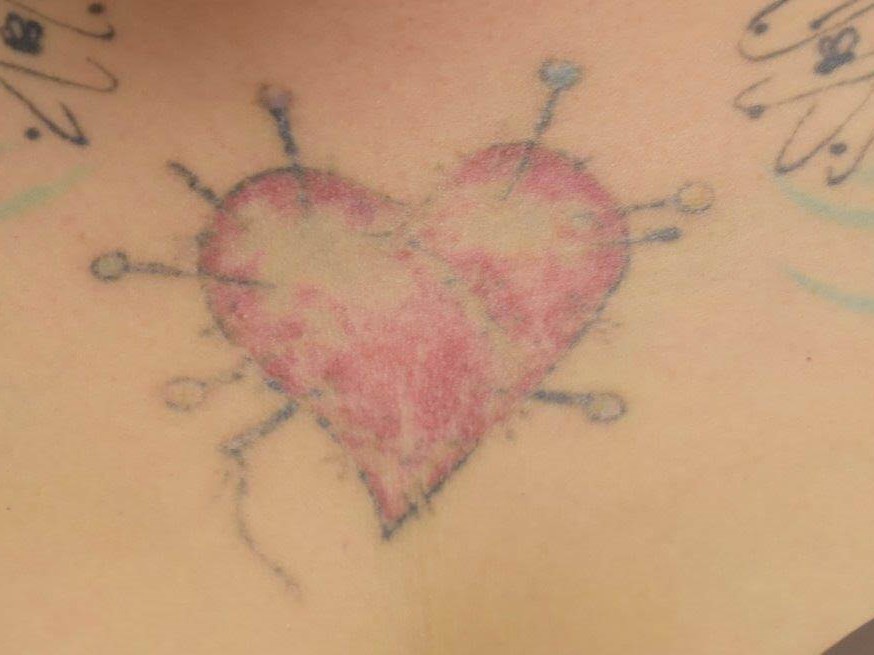 laser tattoo removal laser tattoo removal