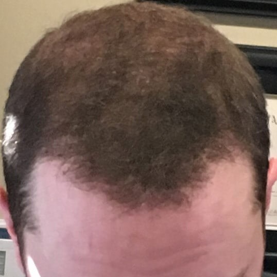 Before And After Fue Photos
