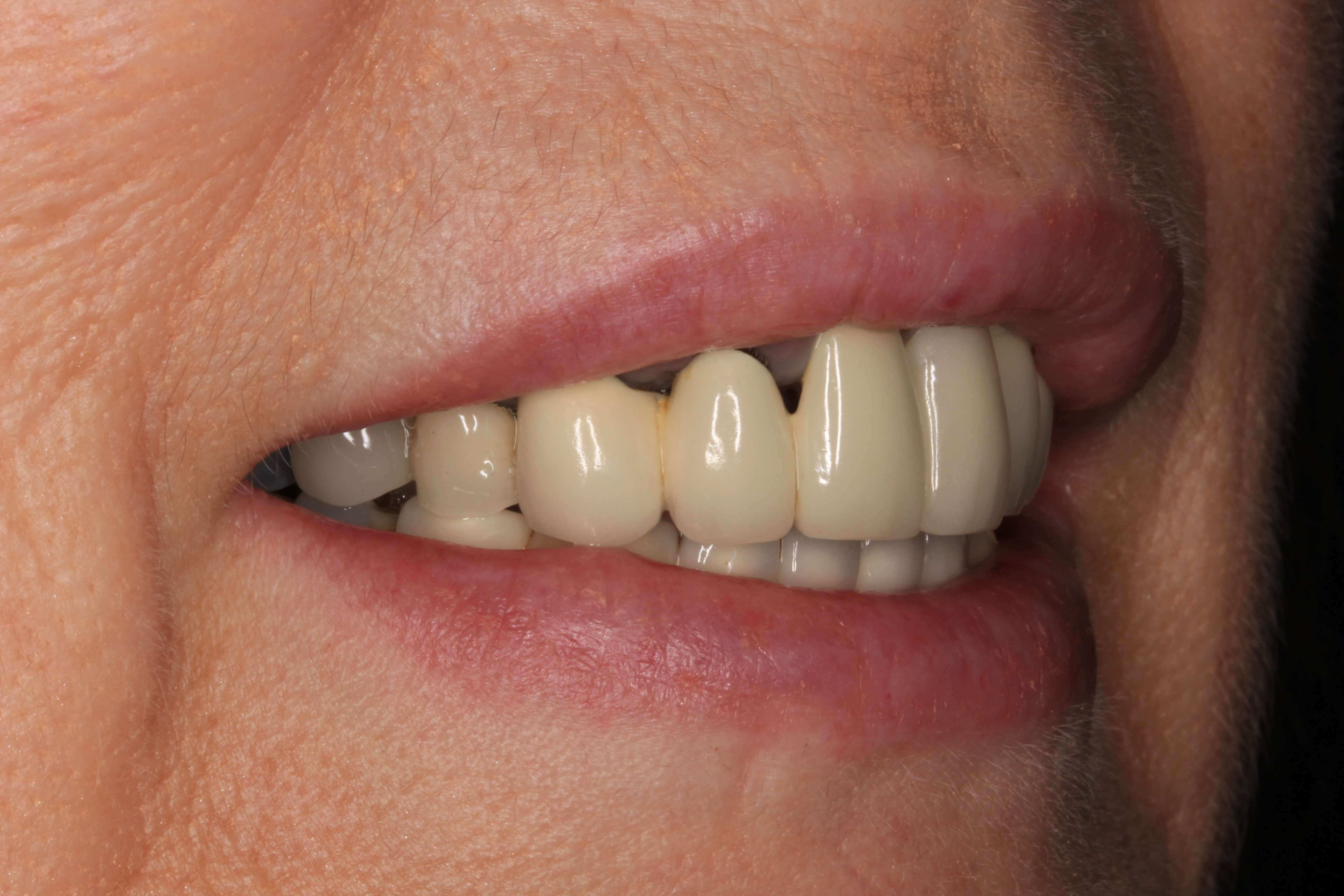 Front Teeth bridge transformation in Rochester Hills, MI