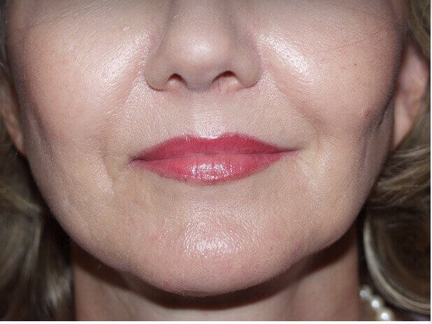 Before and After Lip Lift Photos