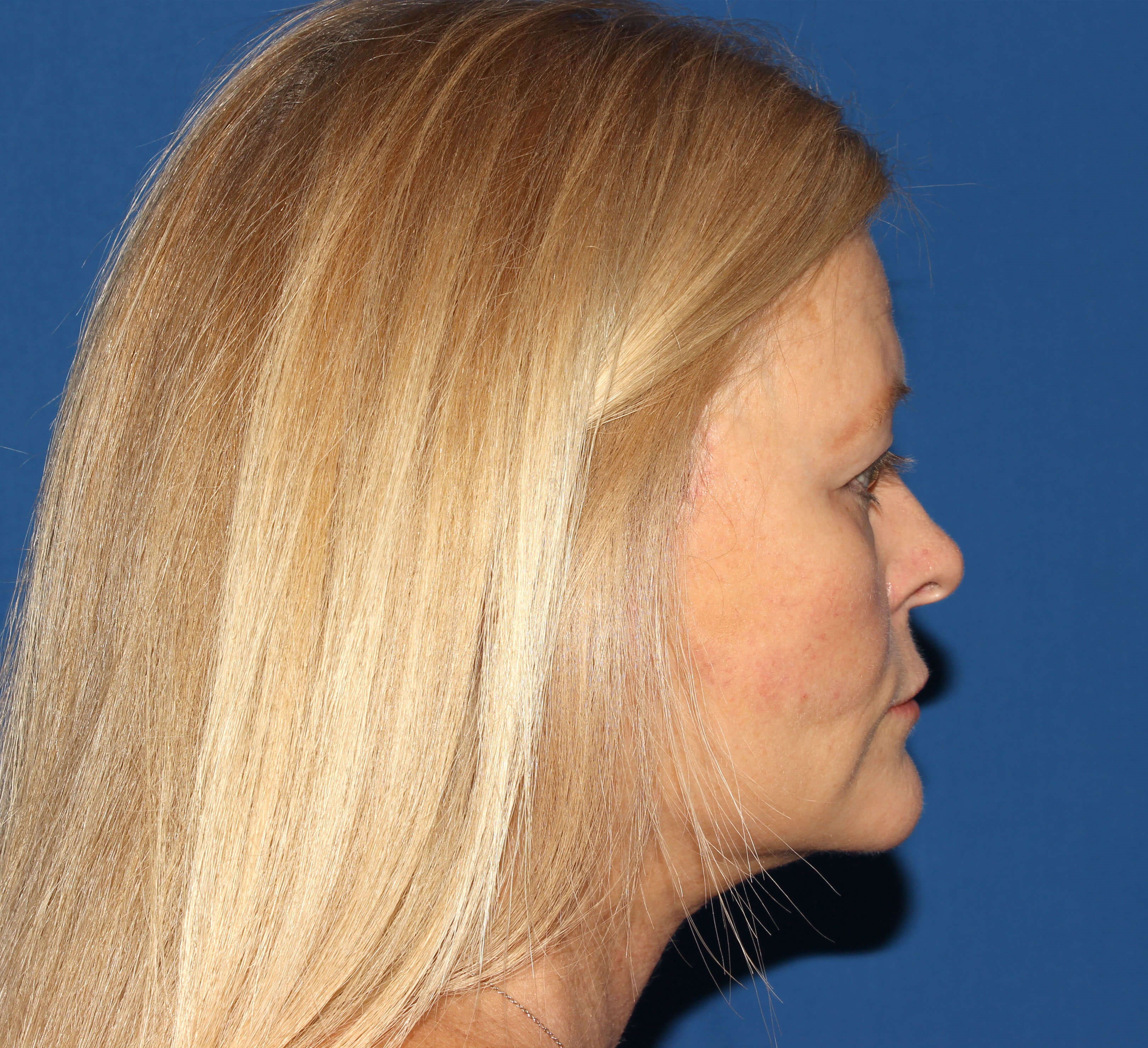 Before and After Facelift Photos